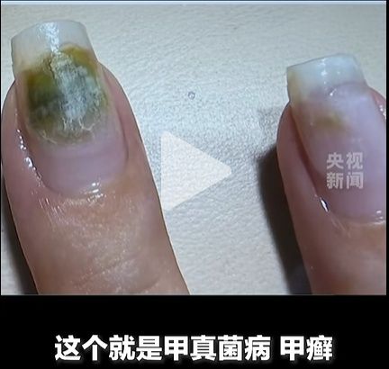 做美甲竟感染HPV，提醒：隐患多，别频繁做